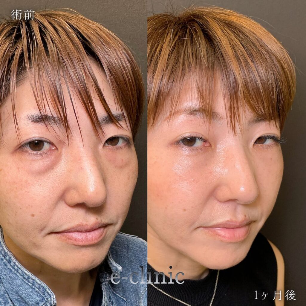 裏ハムラ法と脂肪注入の症例写真 (2)