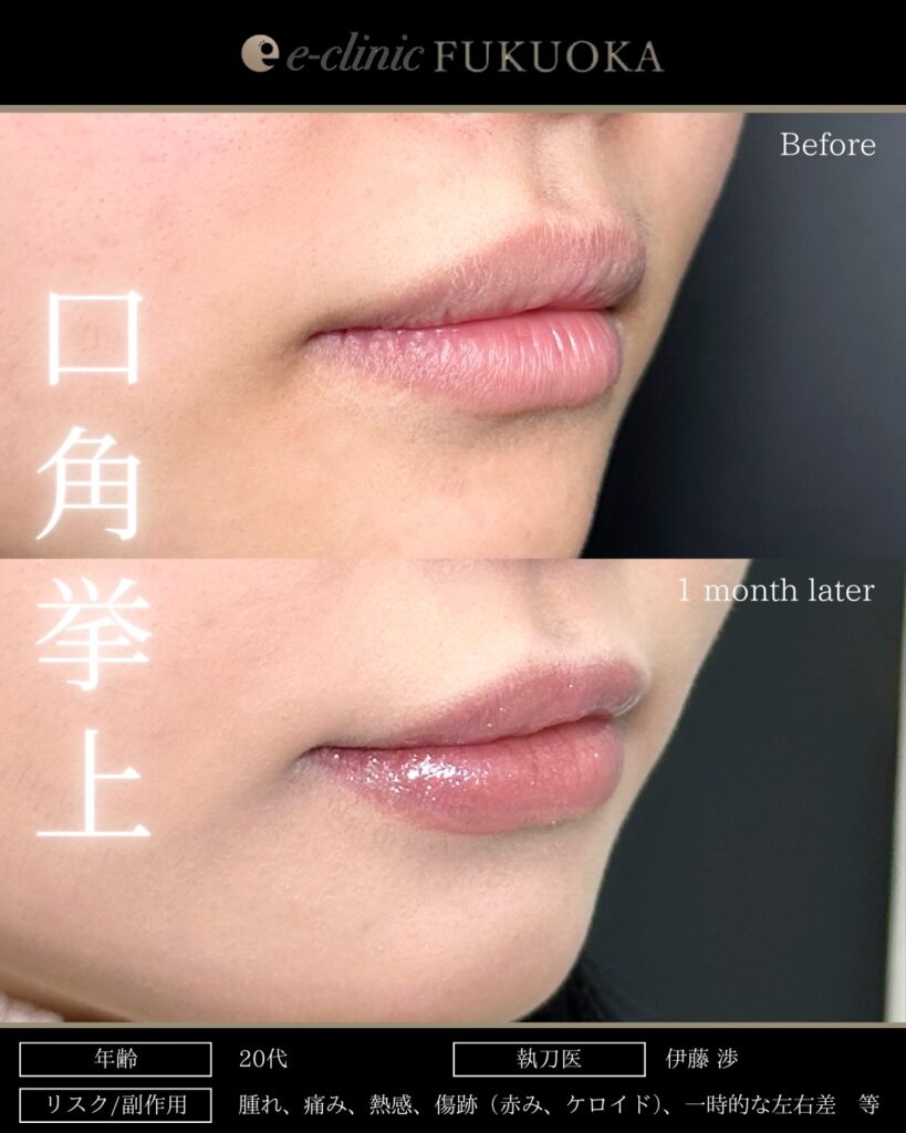 口角挙上の症例写真 (1)