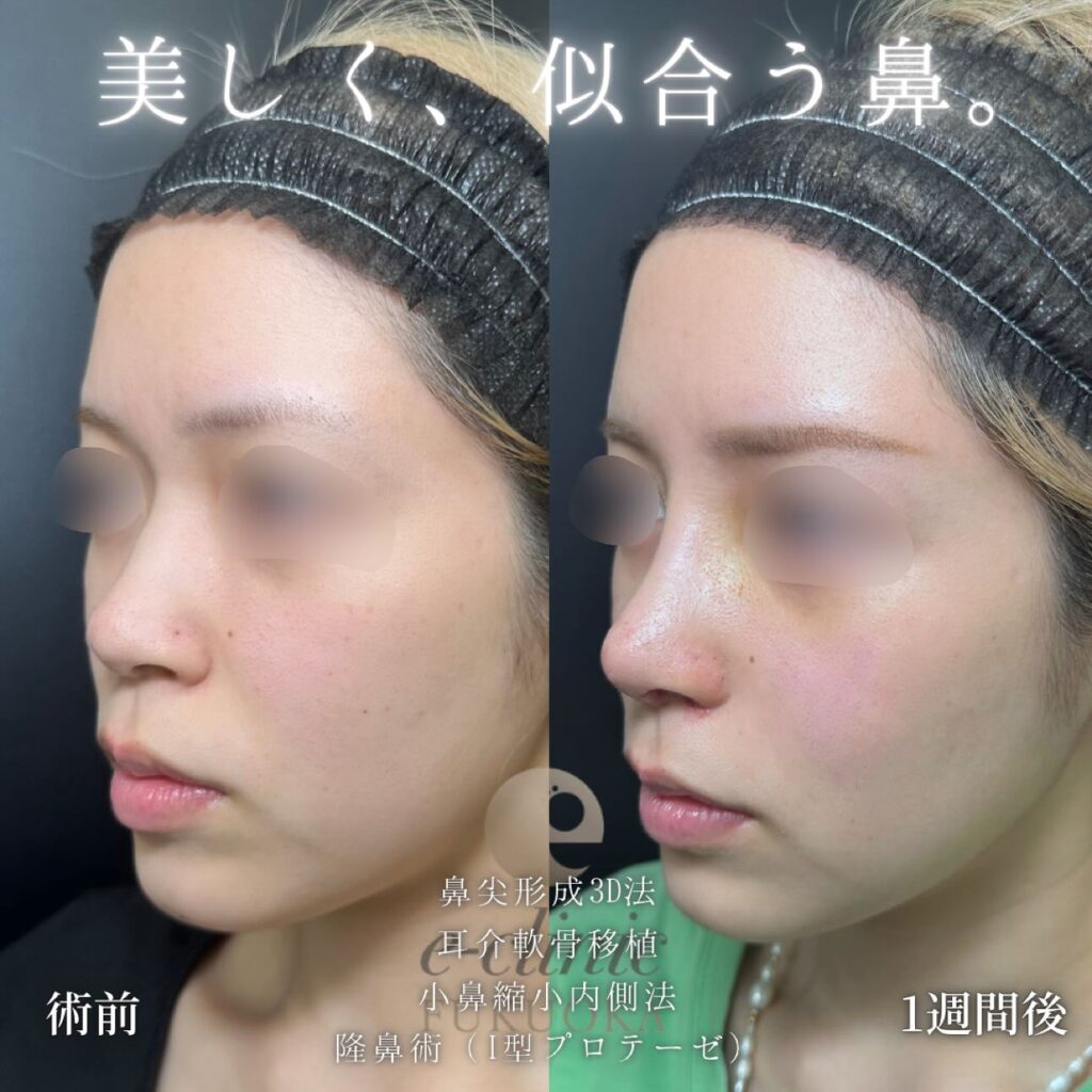鼻尖形成と軟骨移植と小鼻縮小とプロテーゼの症例写真 (1)