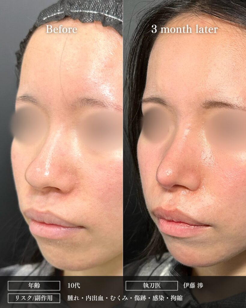 鼻尖形成と軟骨移植と小鼻縮小の症例写真 (39)