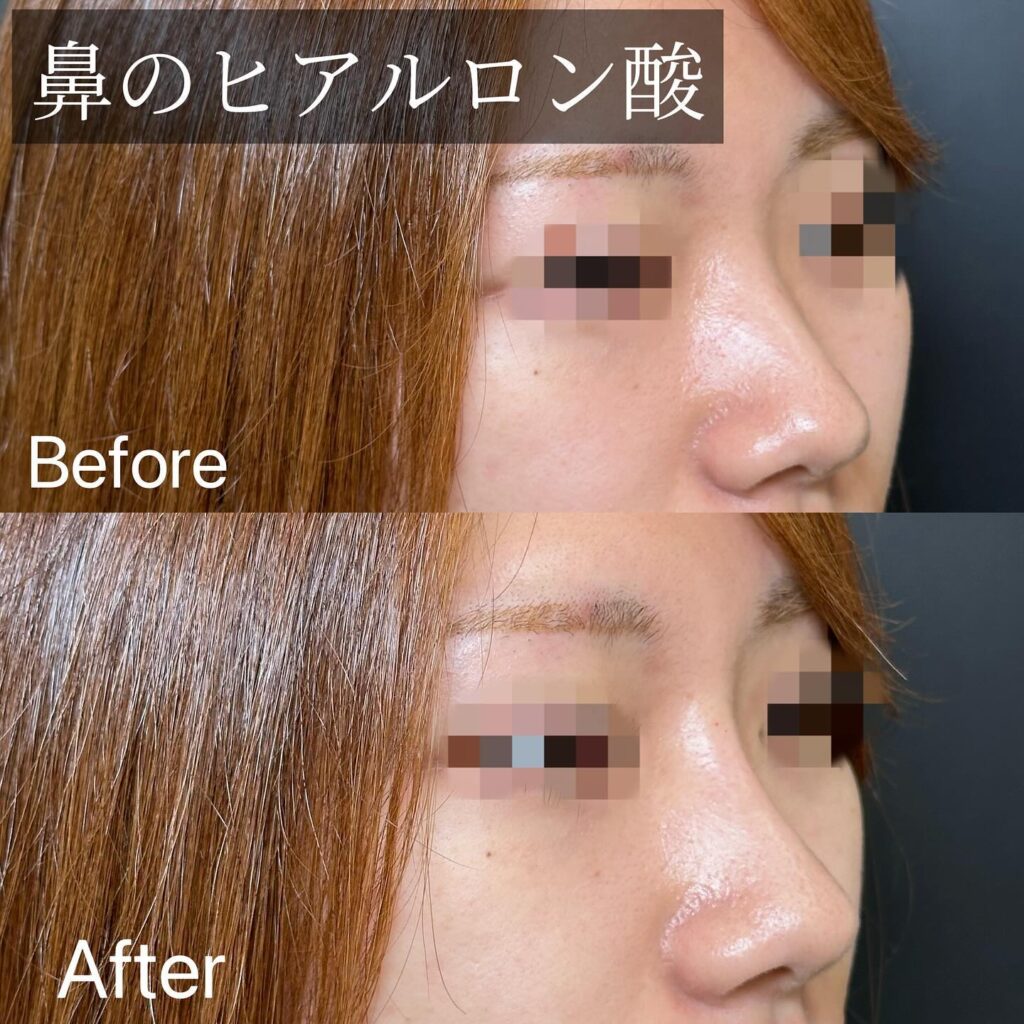 鼻のヒアルロン酸の症例写真 (1)
