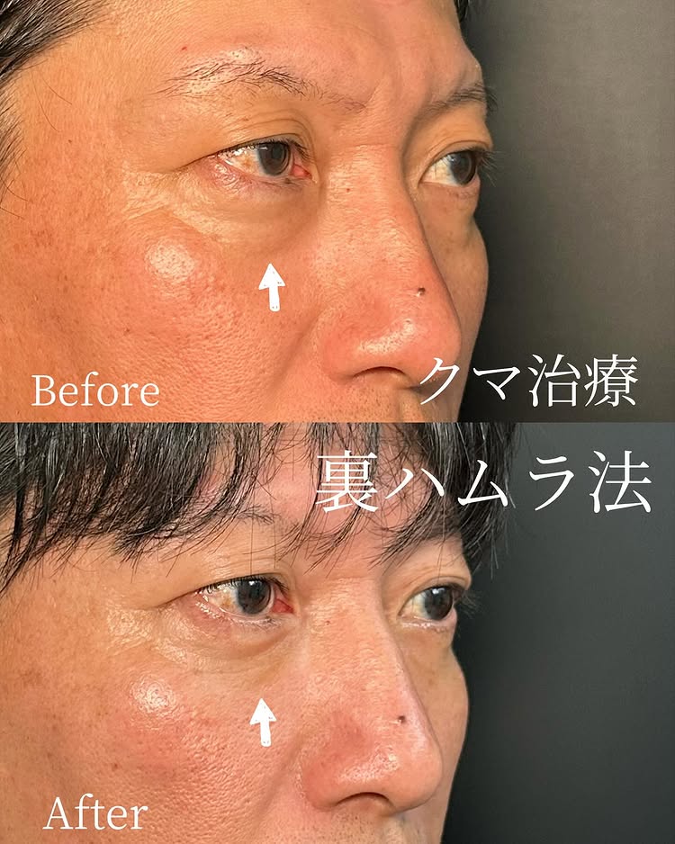 裏ハムラ法の症例写真 (83)