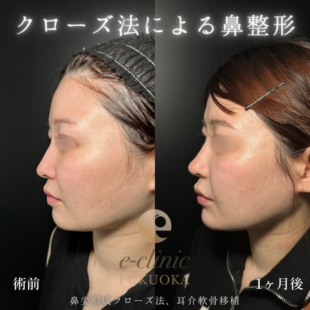 鼻尖形成と軟骨移植の症例写真 (5)