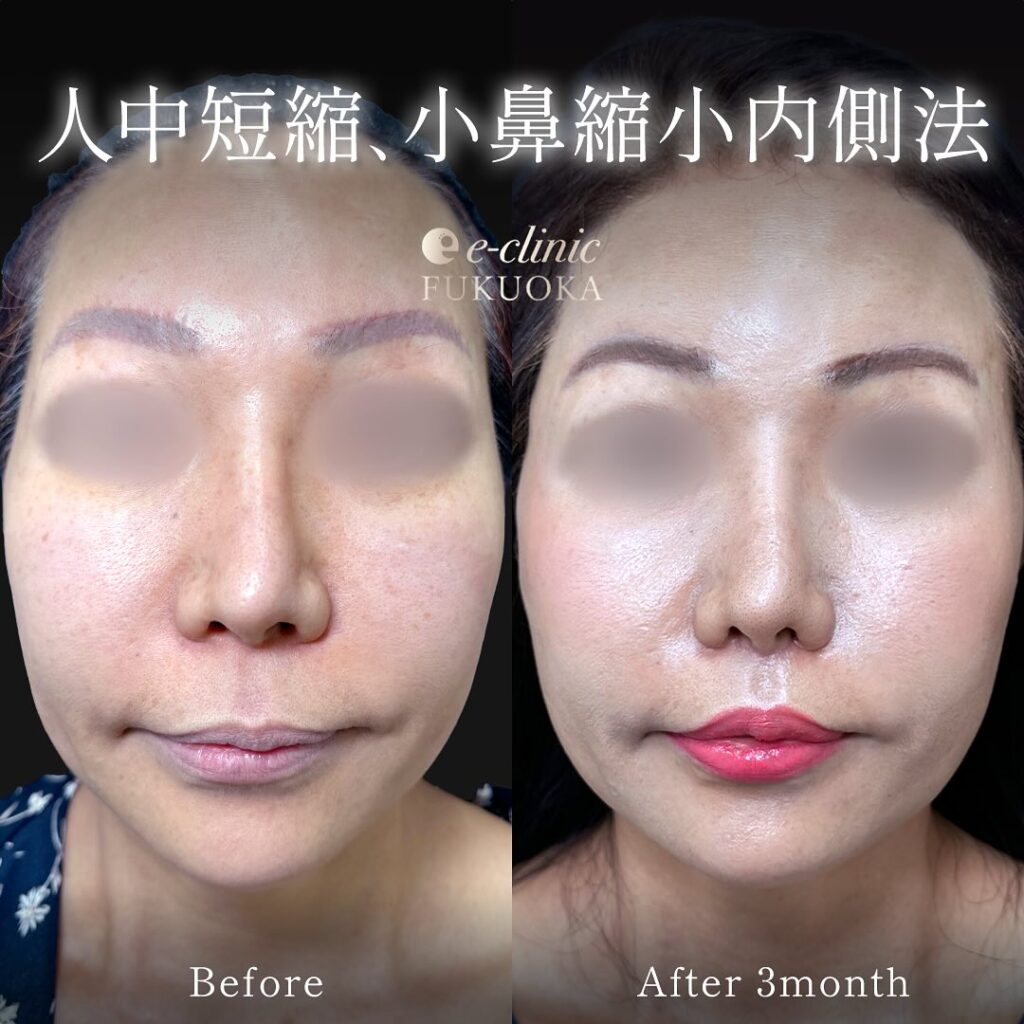 人中短縮と小鼻縮小の症例写真 (4)