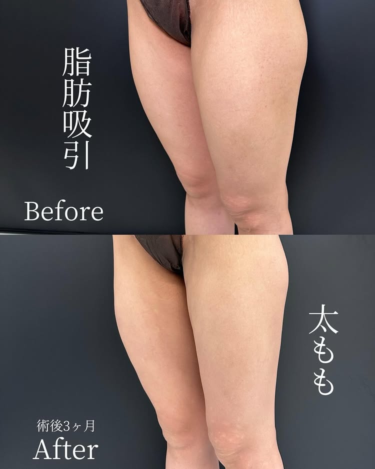 太ももの脂肪吸引の症例写真 (2)