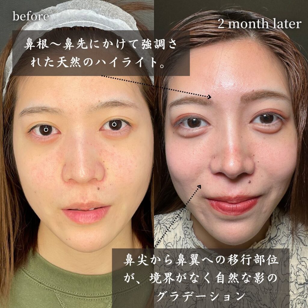 鼻中隔延長と鼻尖形成と耳介軟骨移植とプロテーゼと他院修正の症例写真 (11)