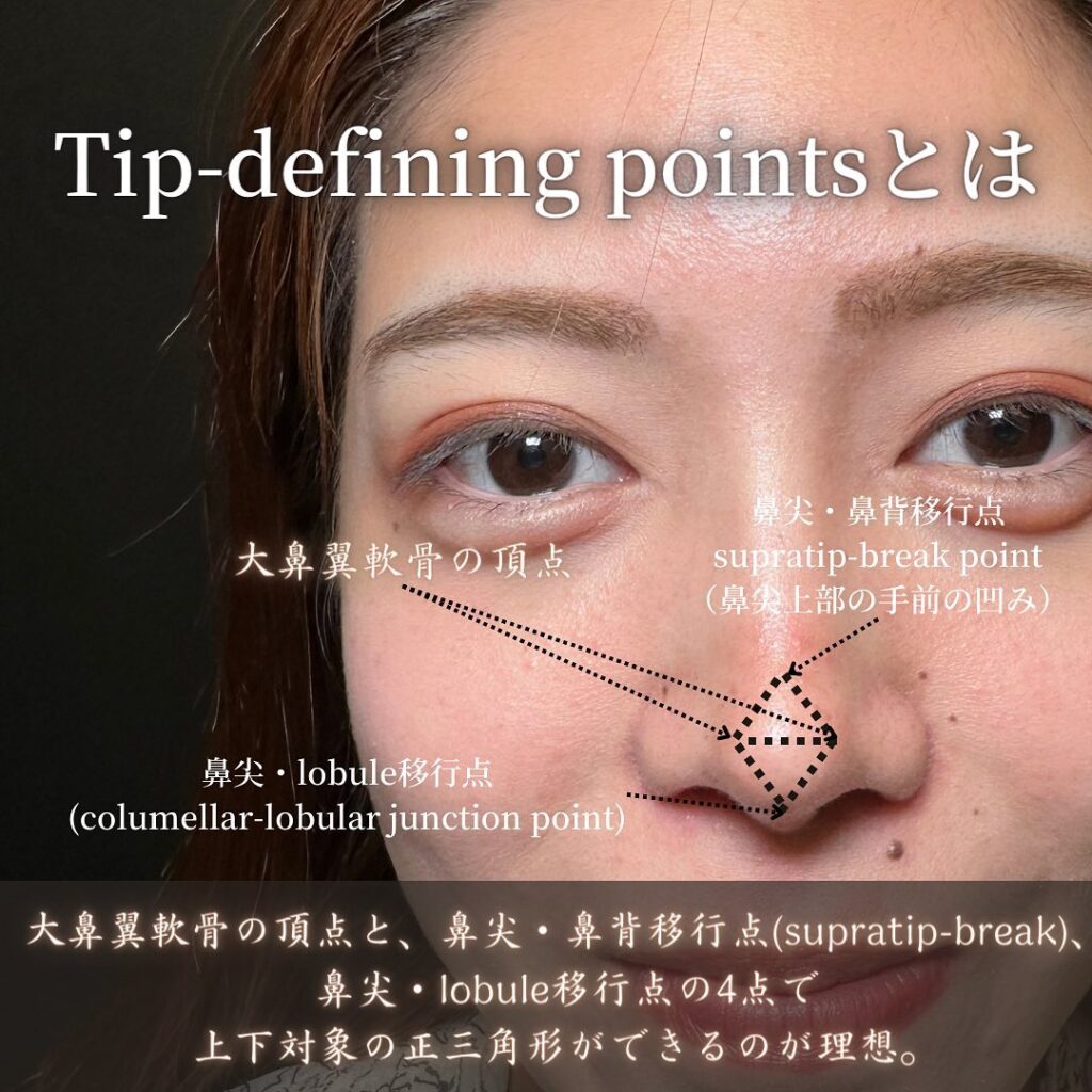 鼻中隔延長と鼻尖形成と耳介軟骨移植とプロテーゼと他院修正の症例写真 (4)