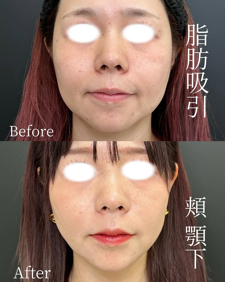 頬と顎下の脂肪吸引の症例写真 (3)