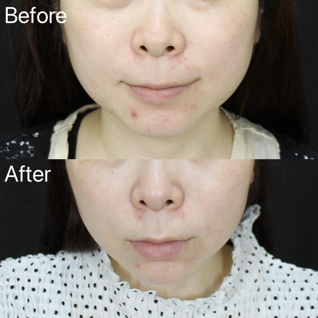 糸リフトの症例写真 (9)