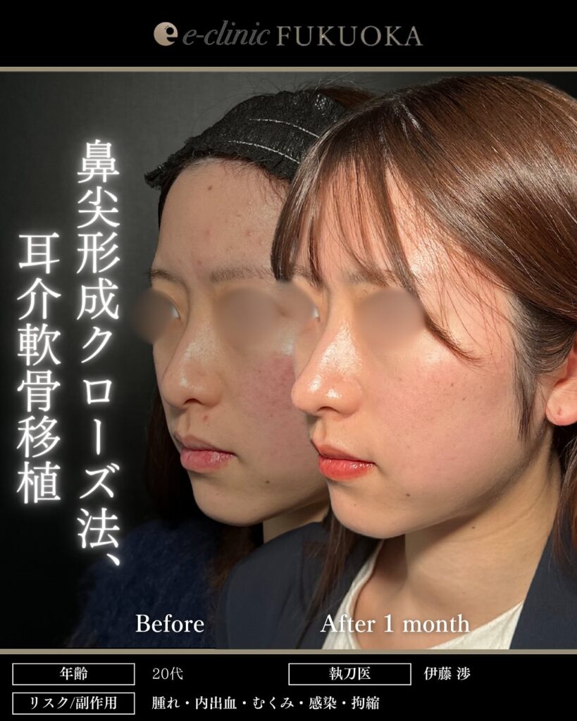 鼻尖形成と軟骨移植の症例写真 (29)