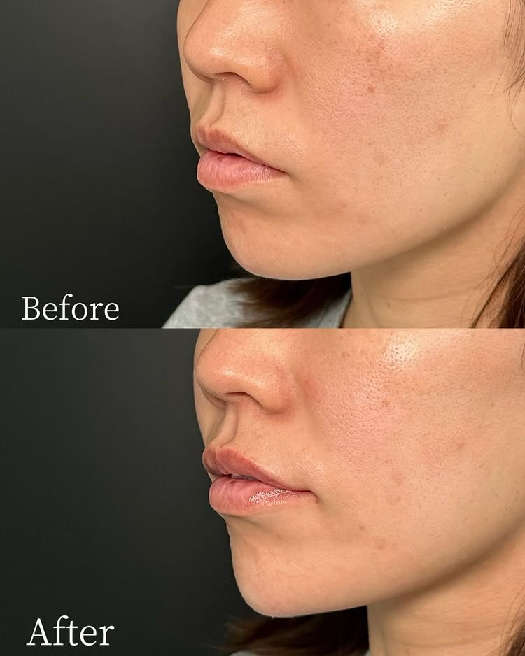 唇のヒアルロン酸の症例写真 (49)