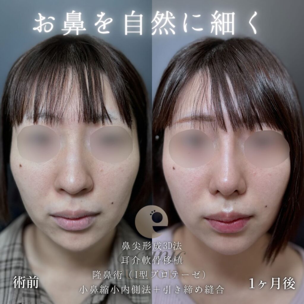 鼻尖形成と軟骨移植とプロテーゼと小鼻縮小の症例写真 (3)