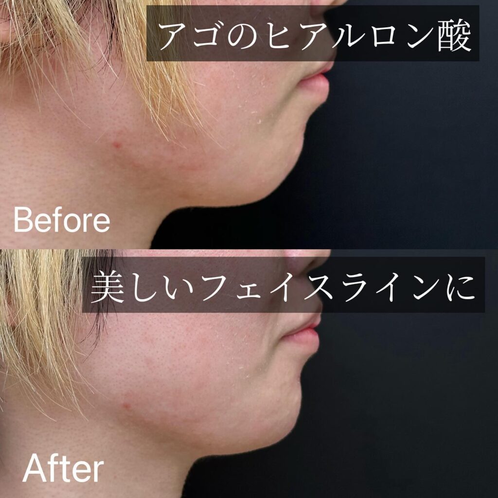 顎のヒアルロン酸注入の症例写真 (1)