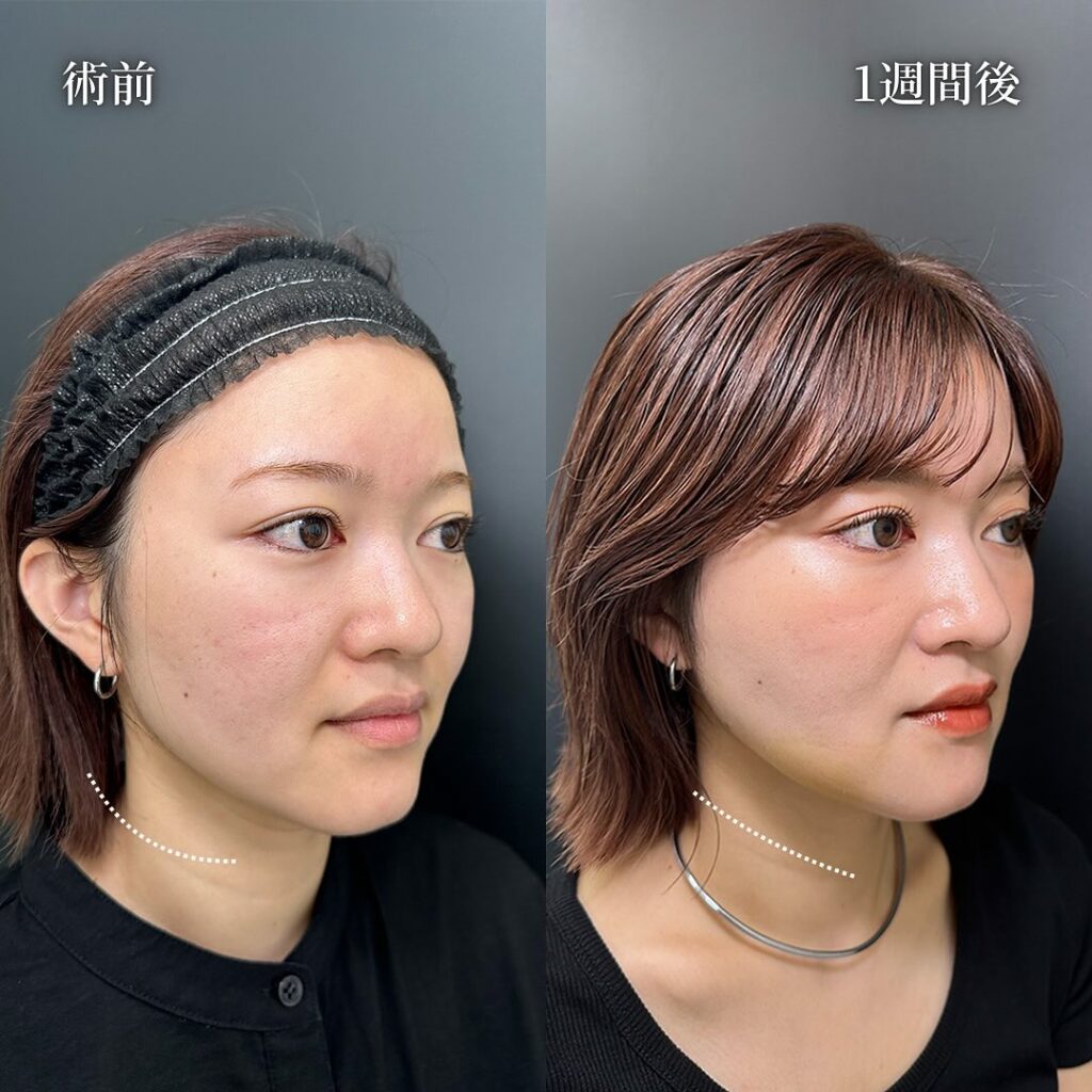 頬の脂肪吸引とジュールファットと糸リフトの症例写真 (2)