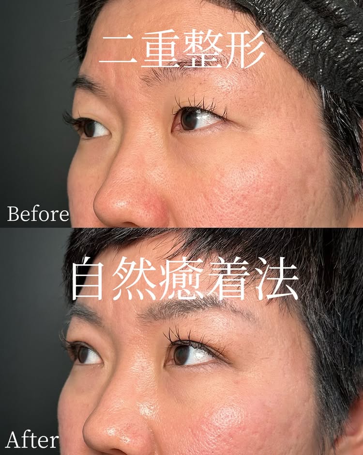 自然癒着法の症例写真 (17)