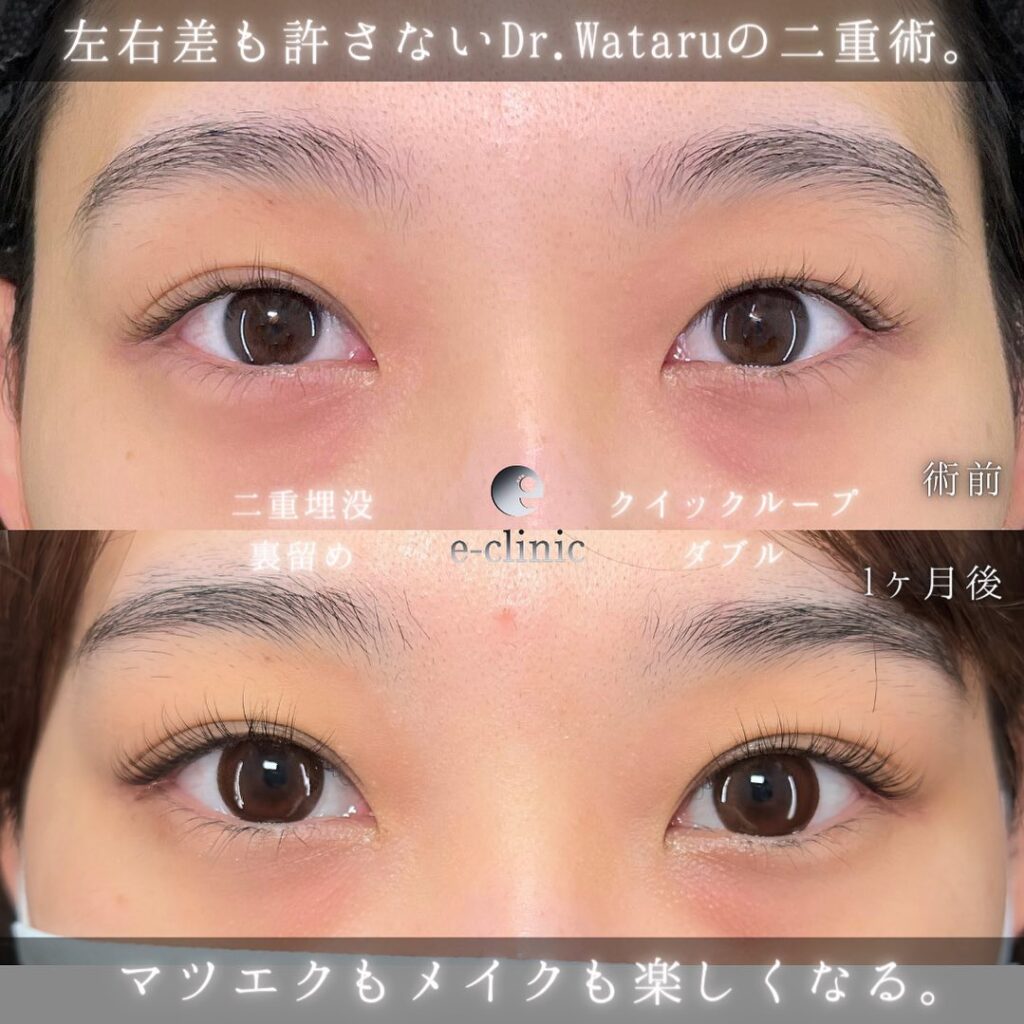 埋没法の症例写真 (7)