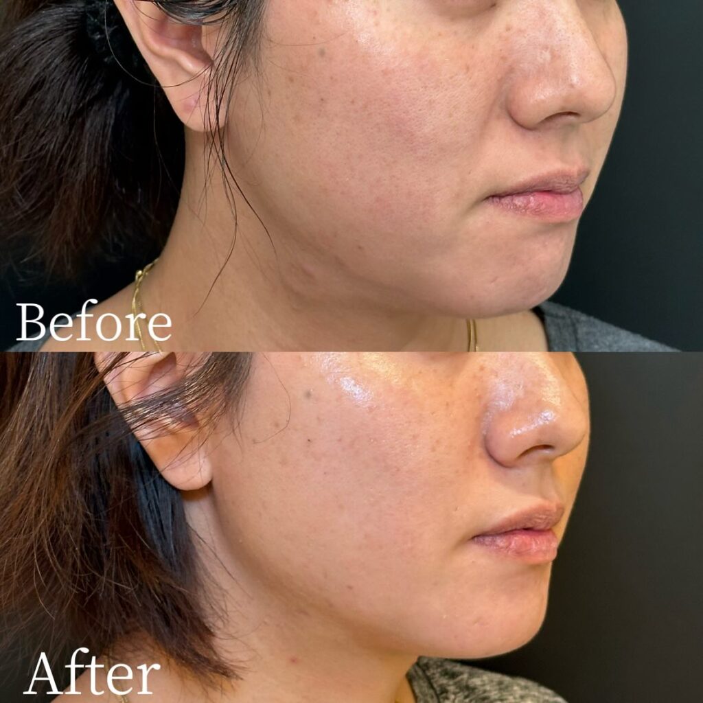 糸リフトの症例写真 (21)