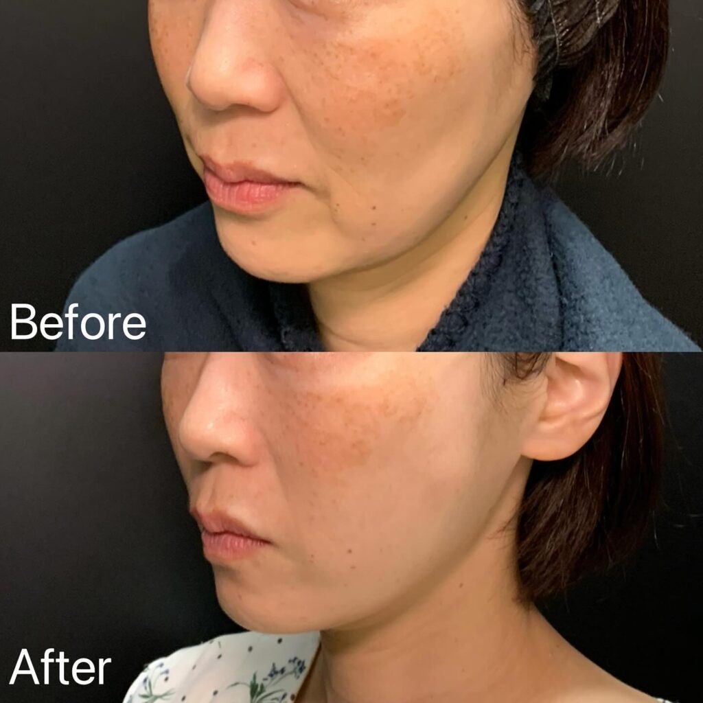 糸リフトの症例写真 (5)