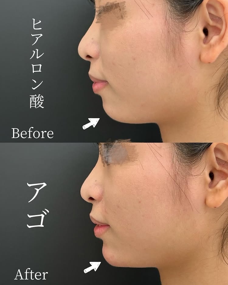 顎のヒアルロン酸の症例写真 (27)