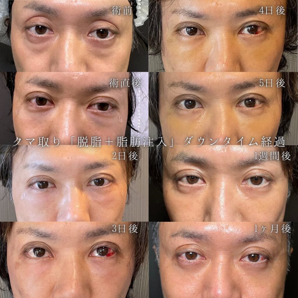 脱脂と脂肪注入の経過の症例写真