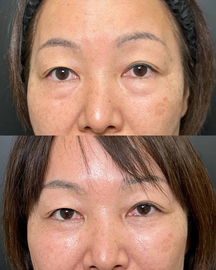 裏ハムラ法の症例写真 (57)