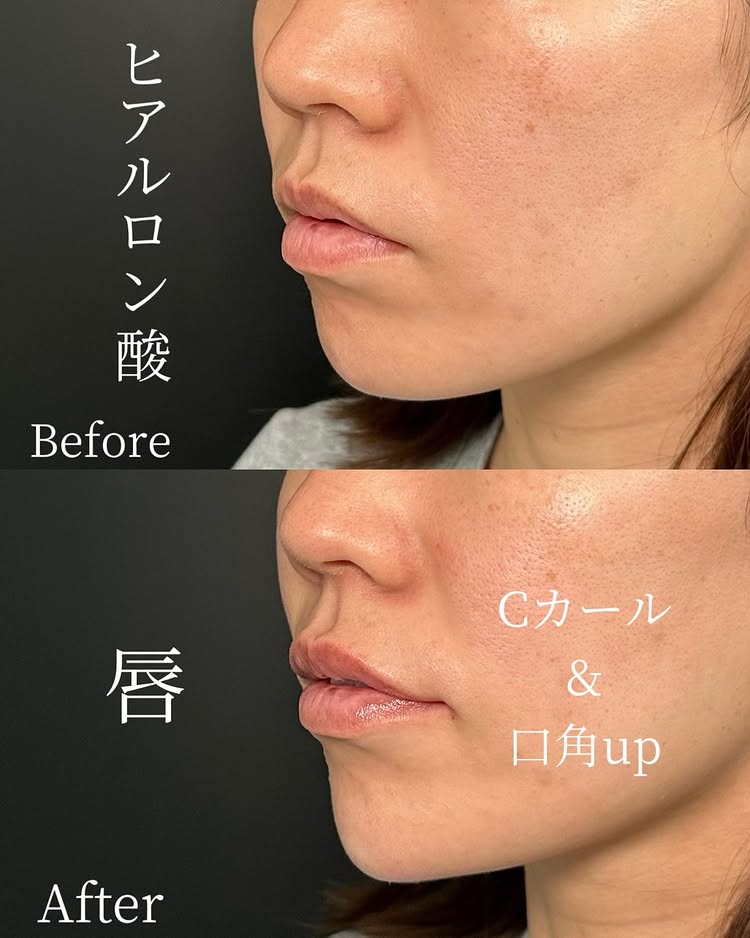 唇のヒアルロン酸の症例写真 (52)