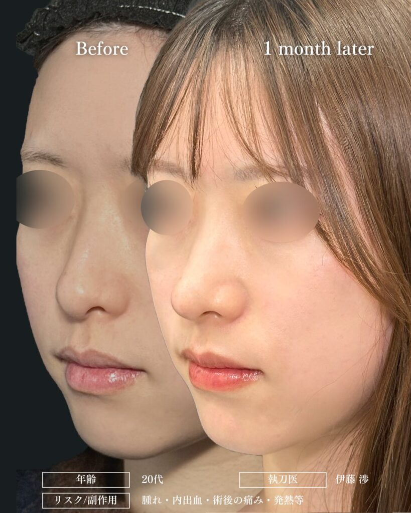 鼻尖形成と軟骨移植とプロテーゼの症例写真 (13)