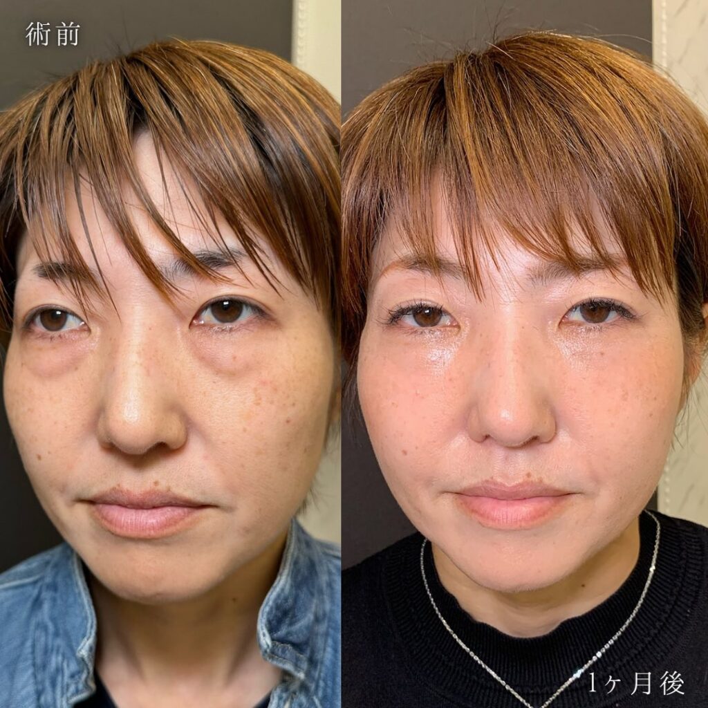 裏ハムラ法と脂肪注入の症例写真 (4)