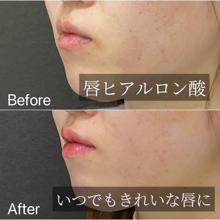 唇のヒアルロン酸の症例写真 (16)