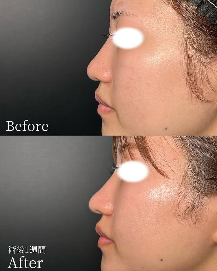 鼻尖形成と軟骨移植の症例写真 (20)