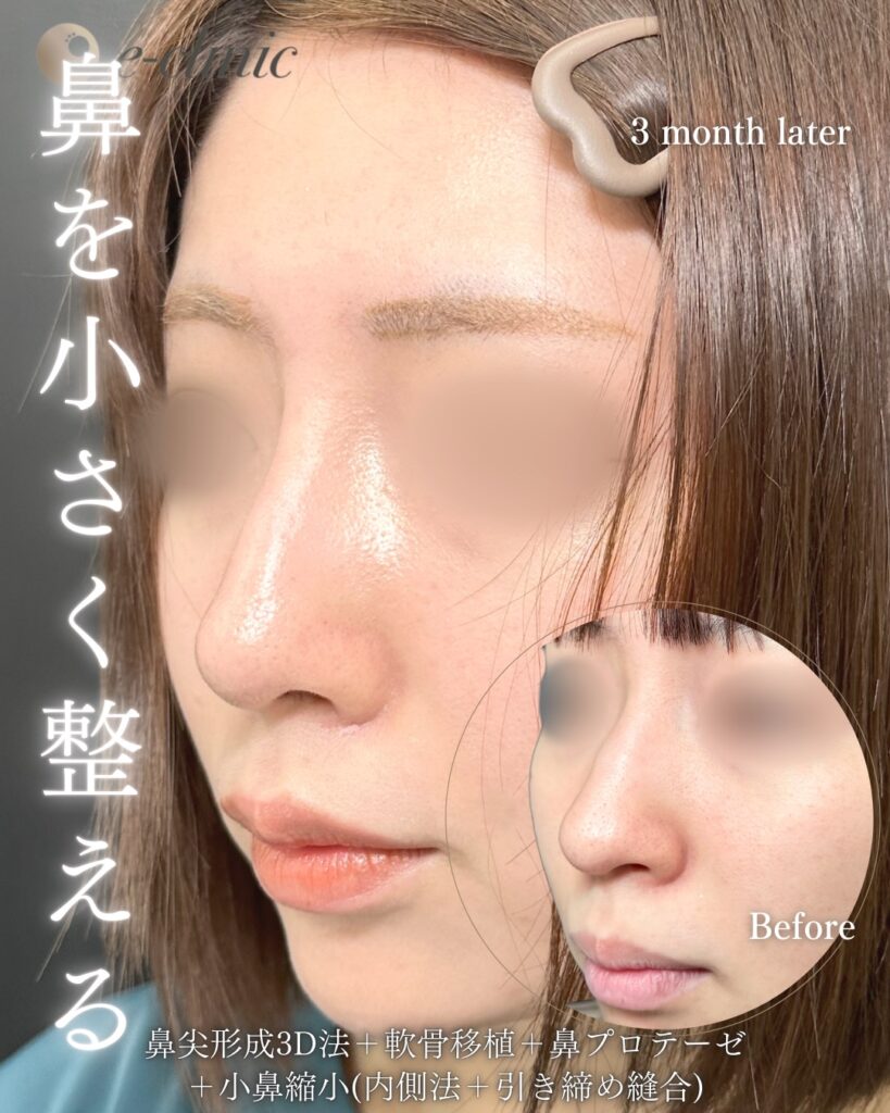 鼻尖形成と軟骨移植とプロテーゼと小鼻縮小の症例写真 (23)
