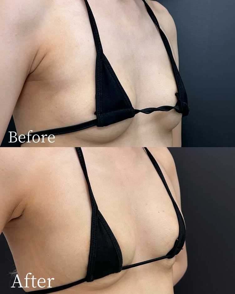 ふんわりバスト注射の症例写真 (2)