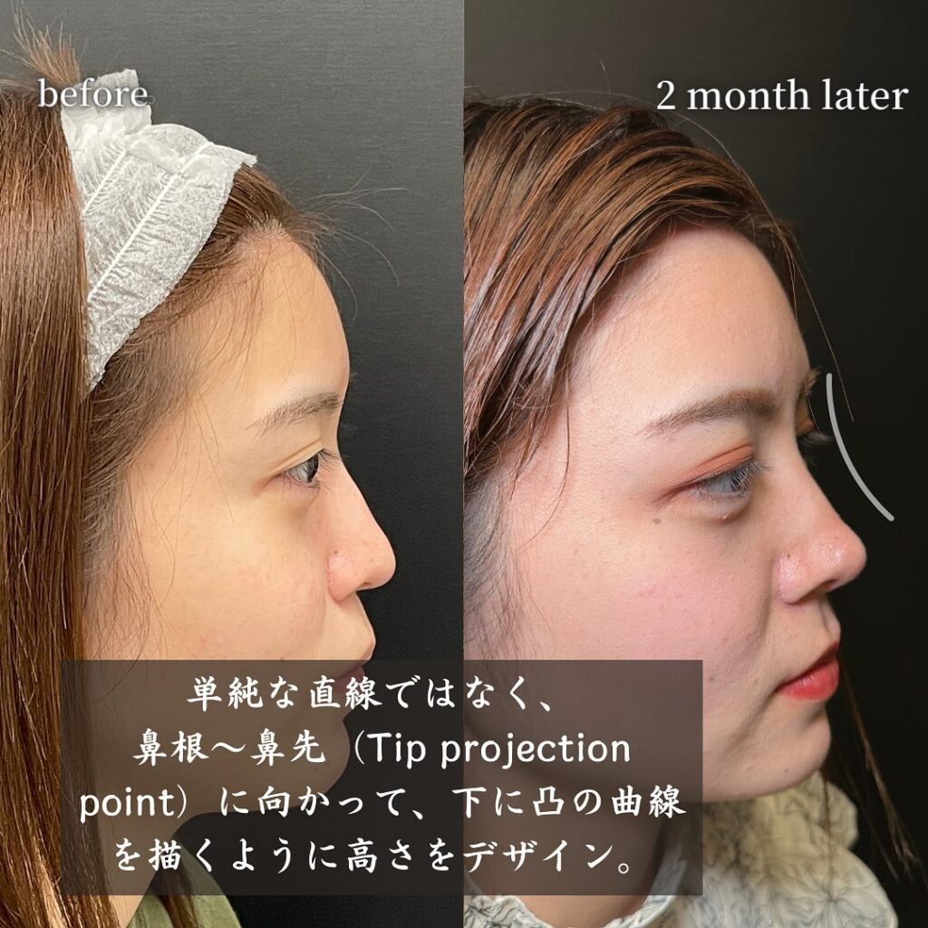 鼻中隔延長と鼻尖形成と耳介軟骨移植とプロテーゼと他院修正の症例写真 (8)