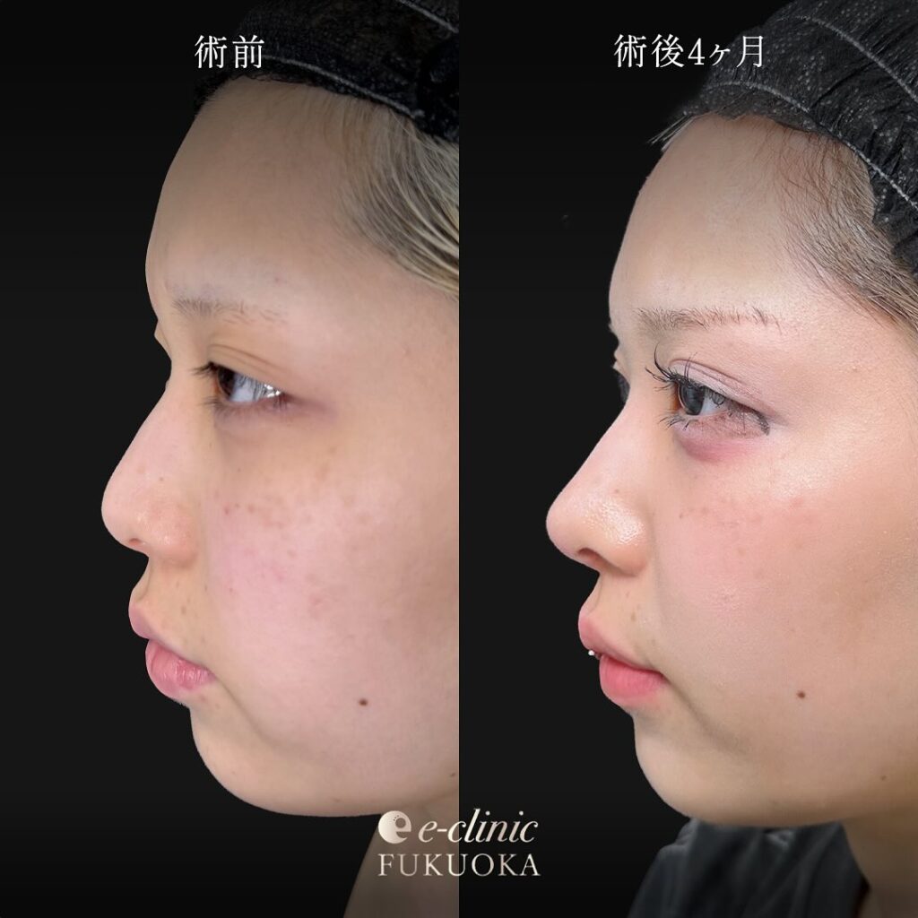 鼻尖形成と軟骨意欲と小鼻縮小の症例写真 (4)