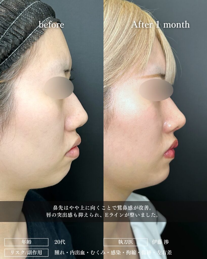 鼻尖形成と耳介軟骨移植と口唇縮小の症例写真 (1)