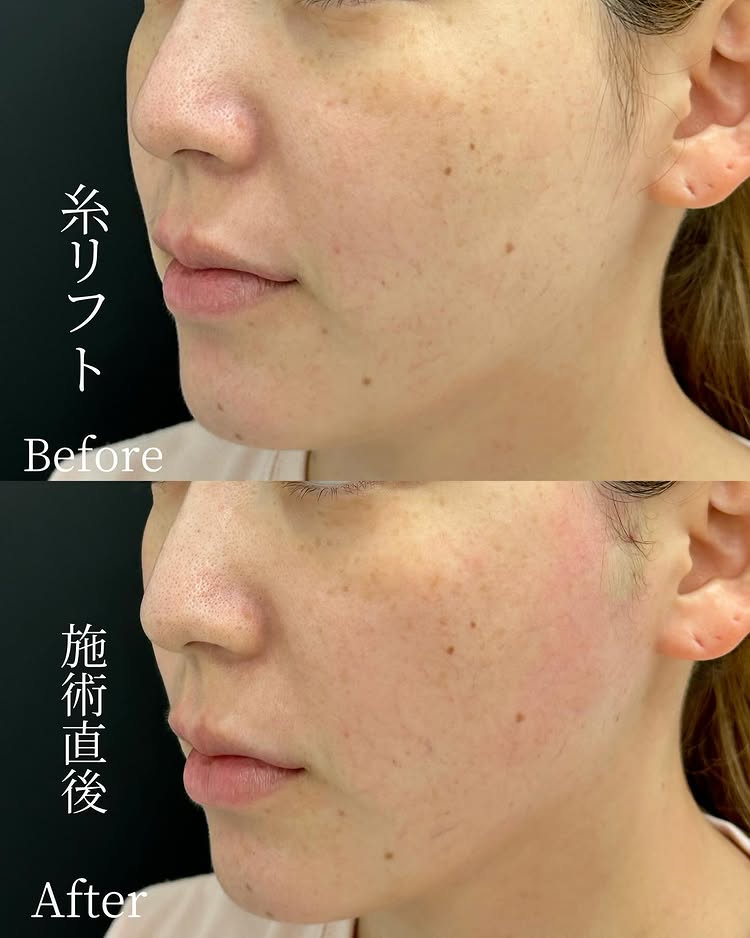 糸リフトの症例写真 (44)