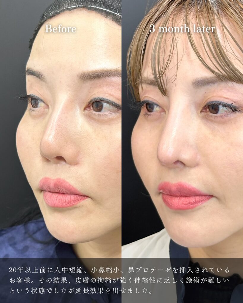 鼻尖形成と軟骨移植とプロテーゼ入れ替えの症例写真 (7)