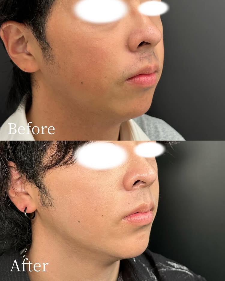 顎下の脂肪吸引の症例写真 (2)