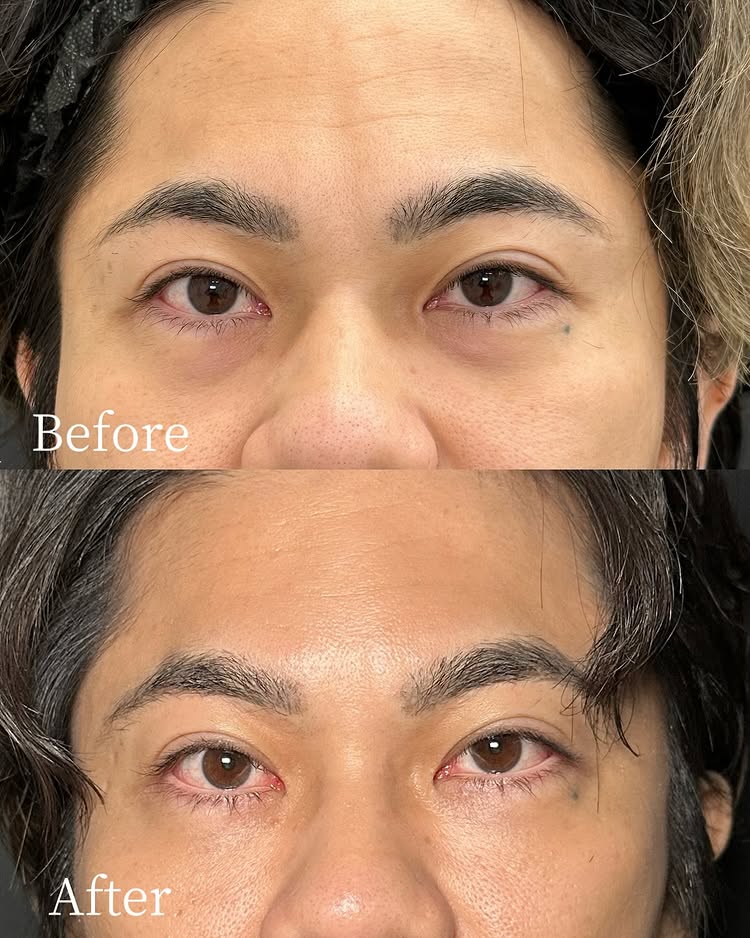 裏ハムラ法の症例写真 (72)