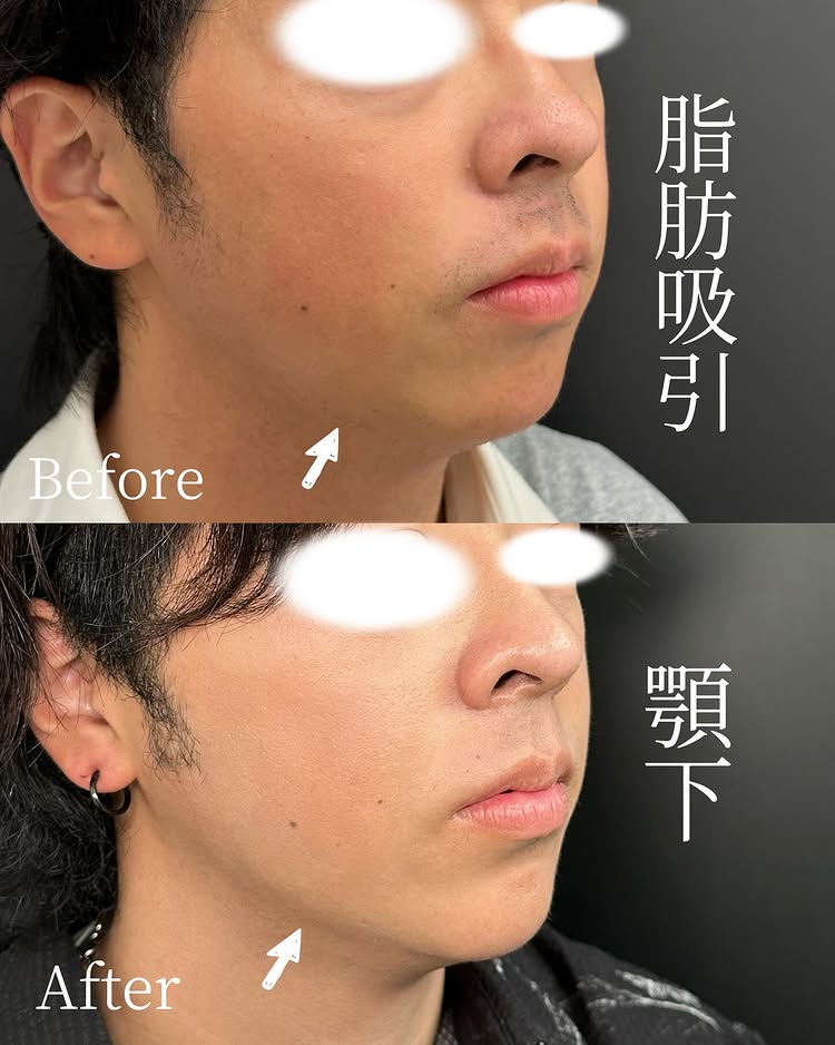 顎下の脂肪吸引の症例写真 (1)