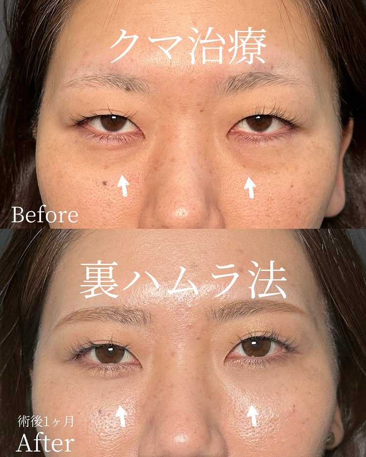 裏ハムラ法の症例写真 (87)