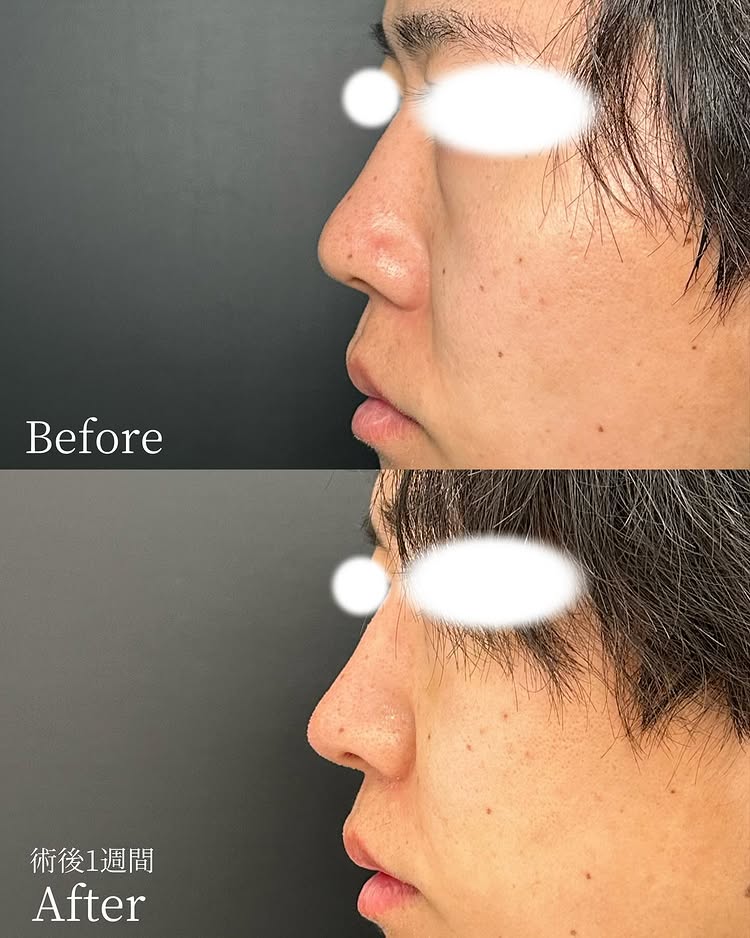 鼻尖形成と軟骨移植の症例写真 (18)