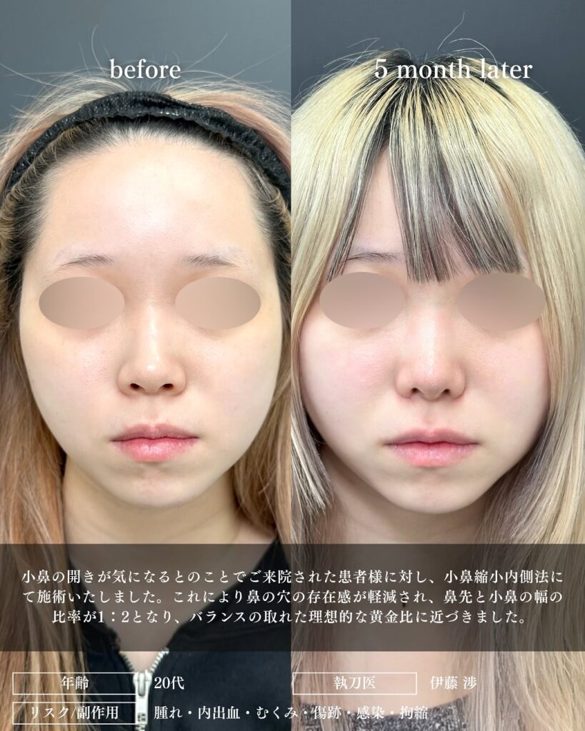 鼻尖形成と軟骨移植と小鼻縮小の症例写真 (30)