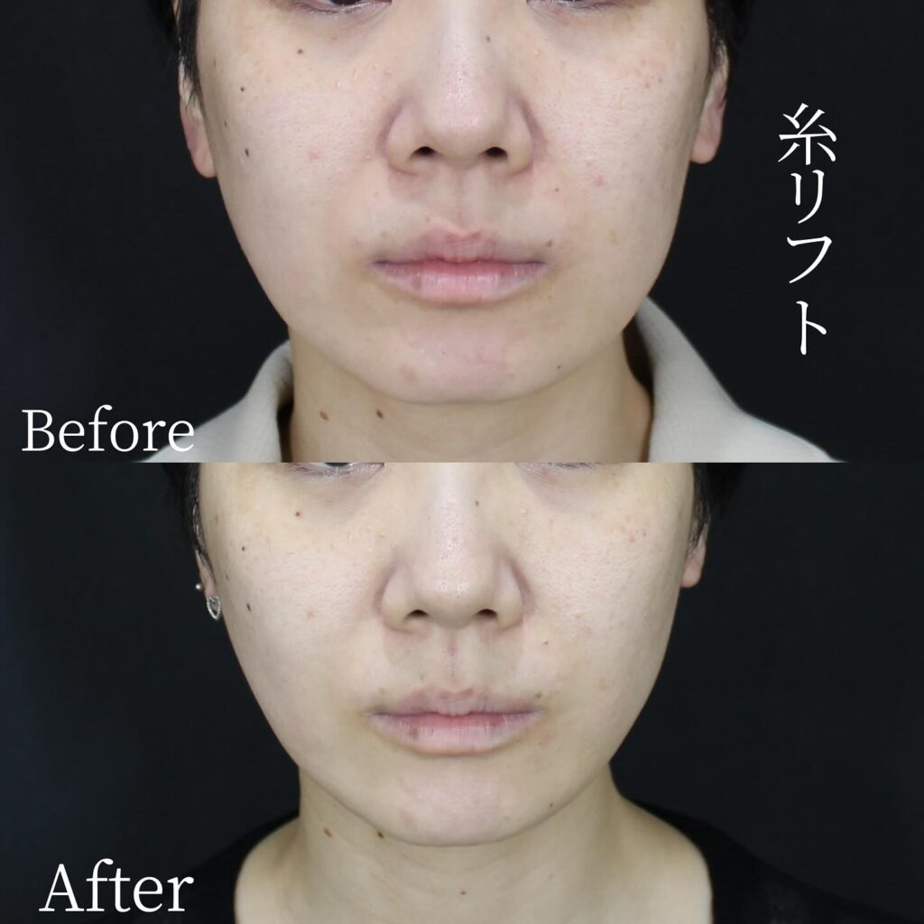 糸リフトの症例写真 (38)