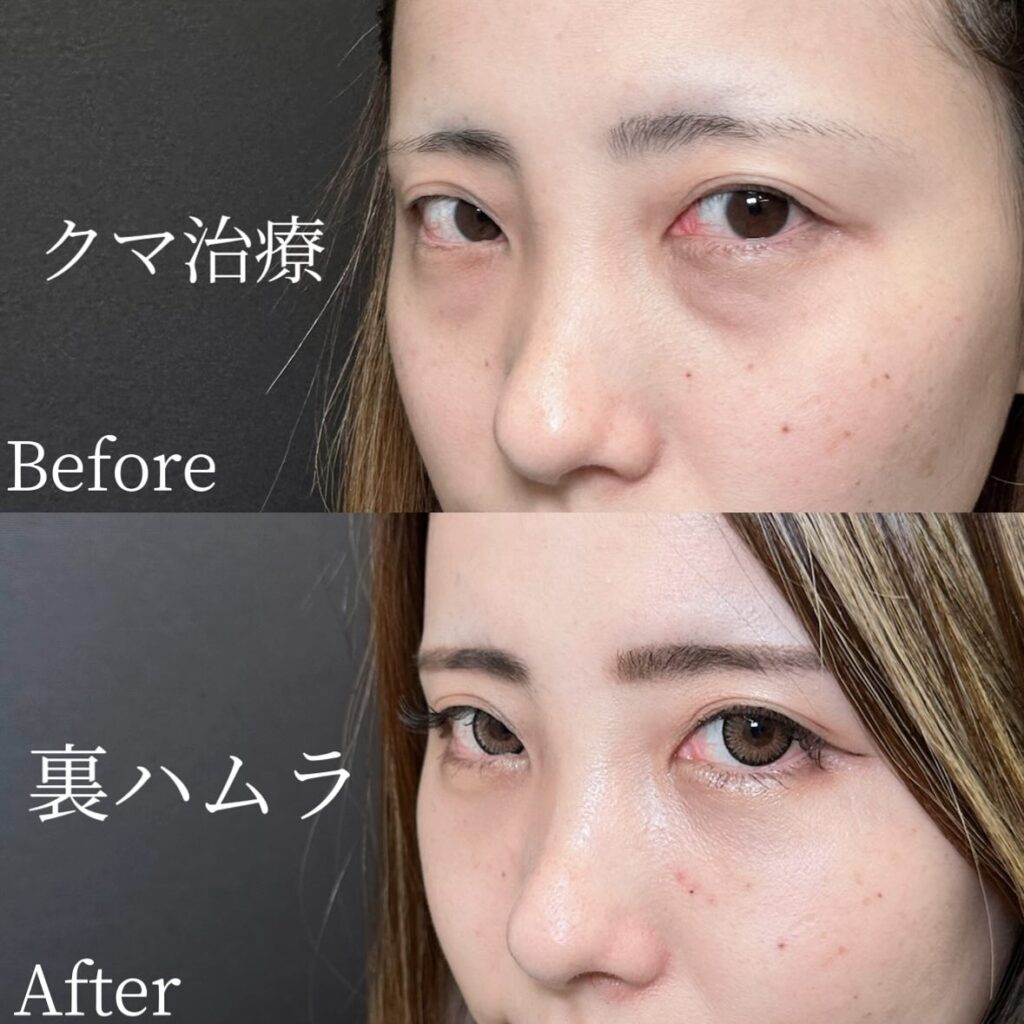 裏ハムラ法の症例写真 (30)