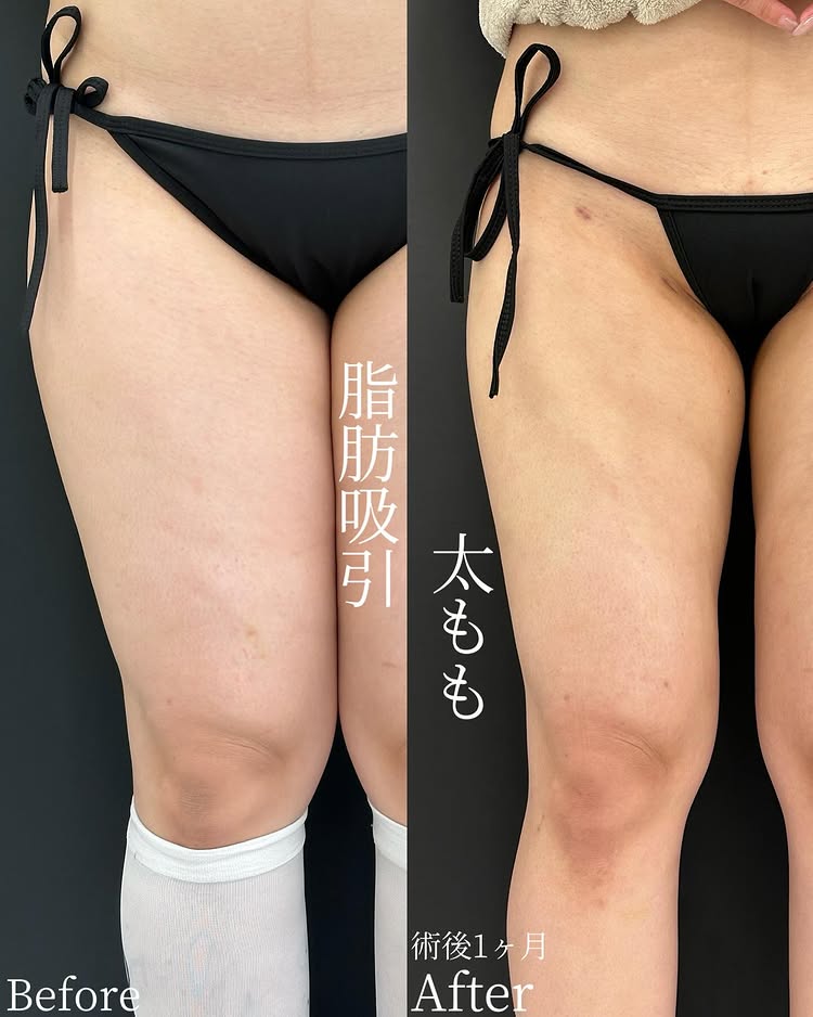 太ももの脂肪吸引の症例写真
