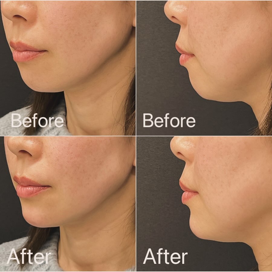 顎のヒアルロン酸の症例写真 (2)