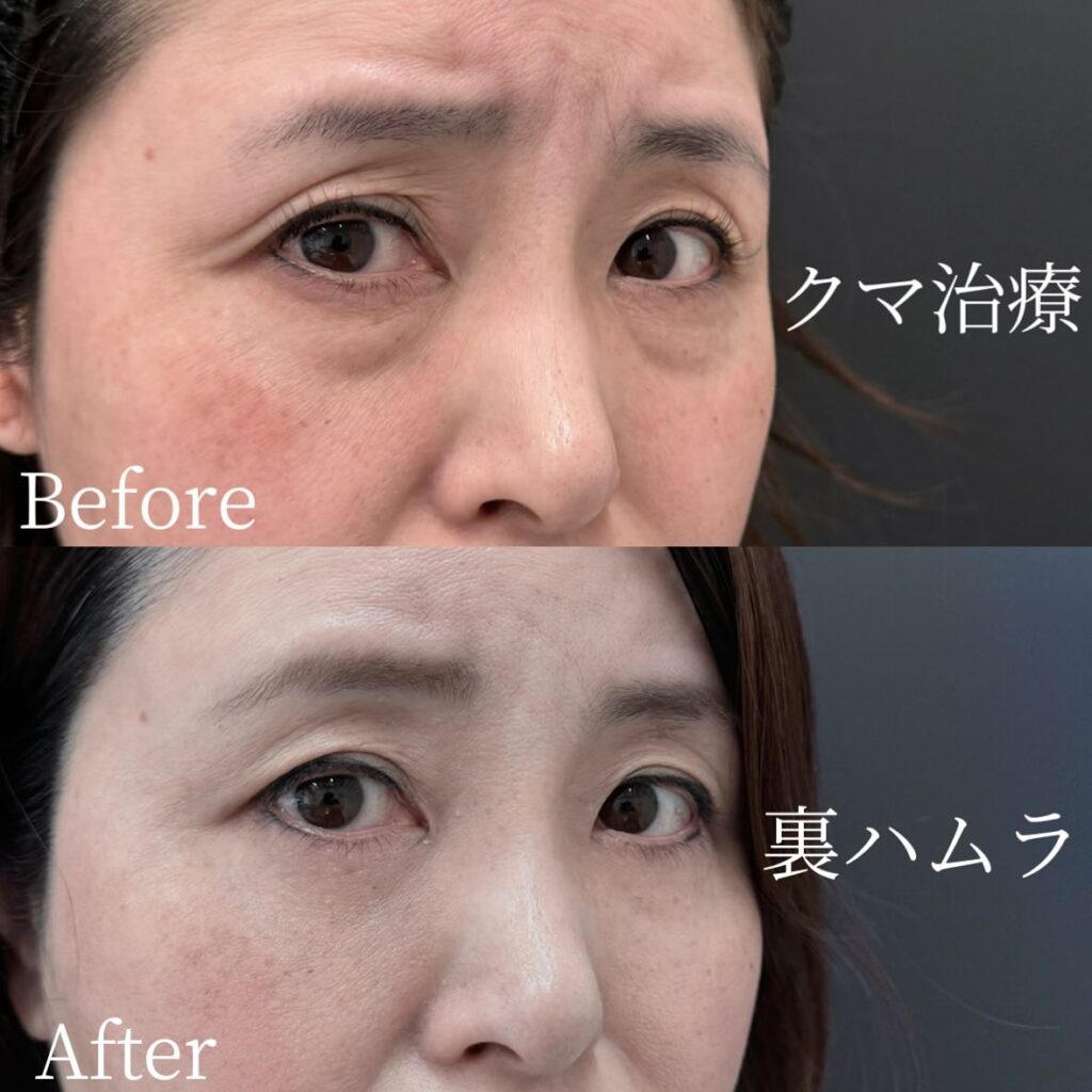 裏ハムラ法の症例写真 (34)