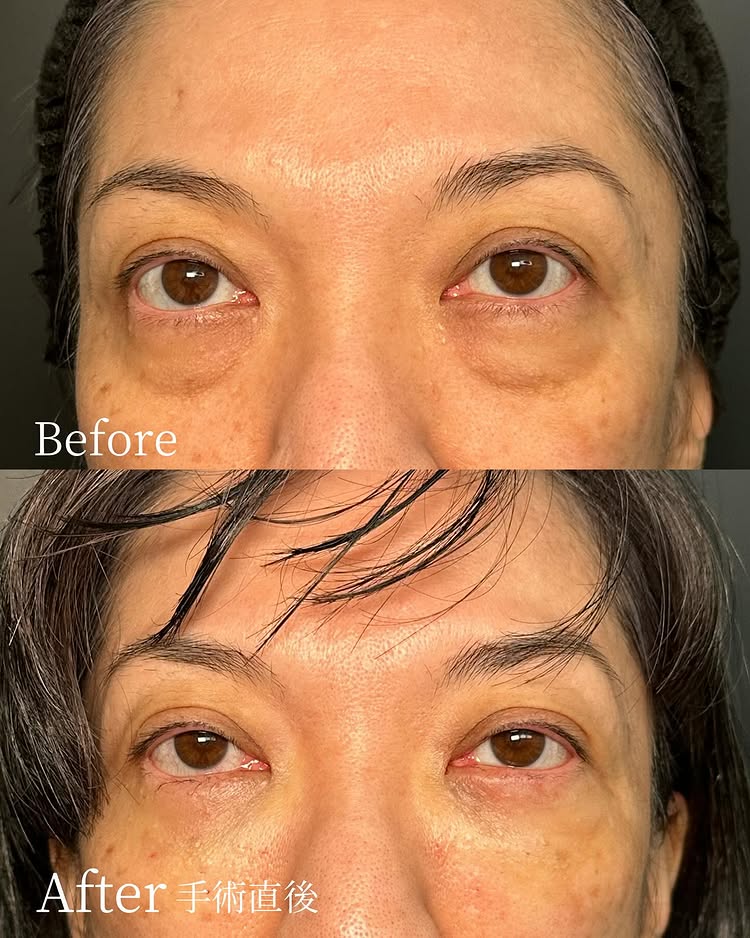 裏ハムラ法の症例写真 (68)