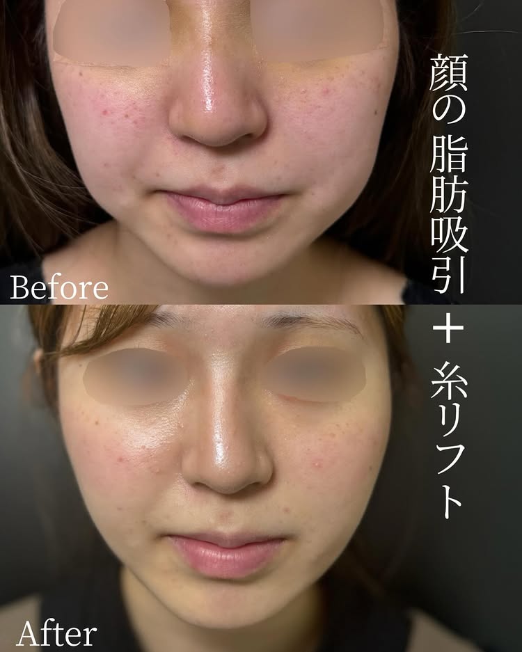 頬と顎下の脂肪吸引と糸リフトの症例写真 (1)